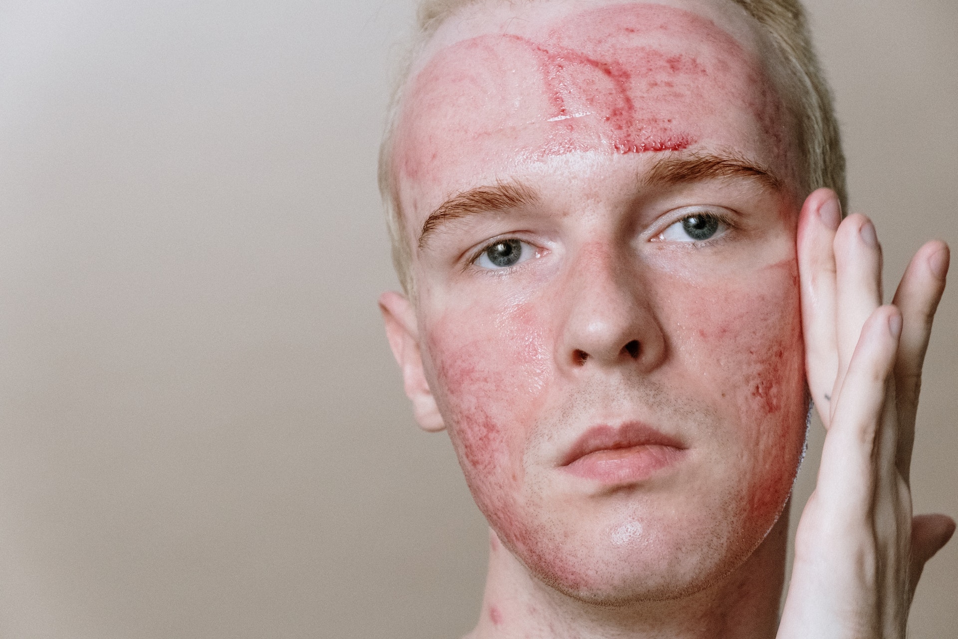 rosacea on skin