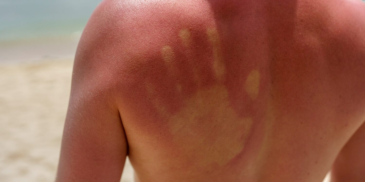 How to Prevent Sun Damage for Skin and Hair with Home Remedies How to Prevent Sun Damage for Skin and Hair with Home Remedies