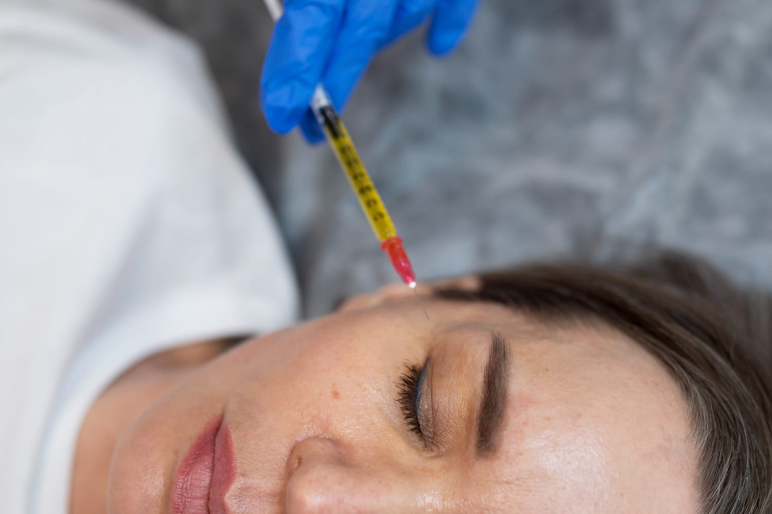 woman getting PRP facial